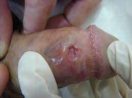 Lesão no pênis causado pela Sífilis